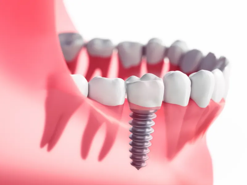 Ilustração de um implante dentário com coroa entre dois dentes